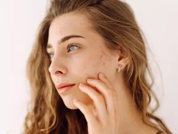 Acné hormonale femme