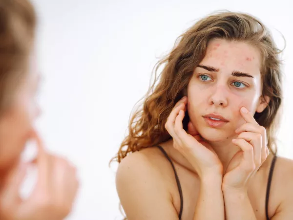 acné hormones femme adulte